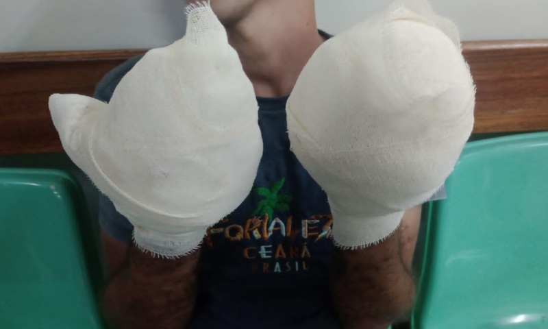 Homem torturado diz que teve os dedos torados por traficantes em Manaus
