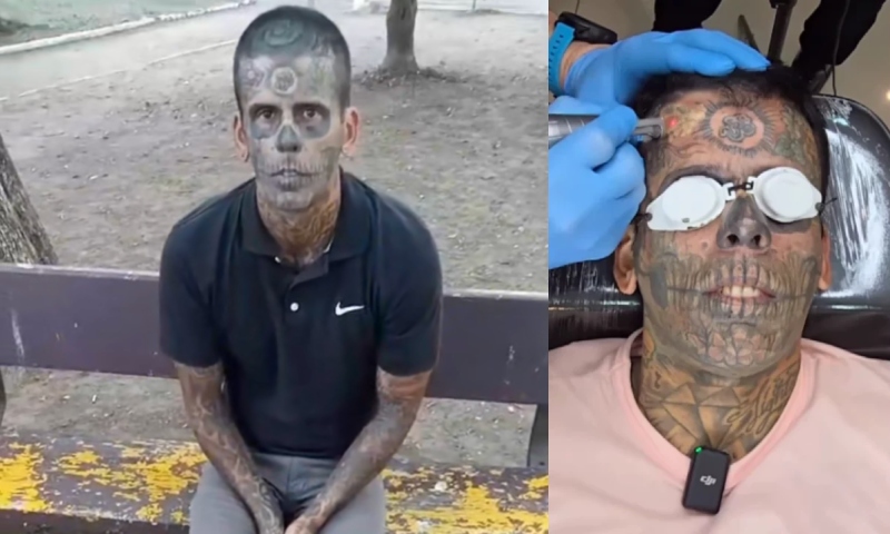 Homem se converte e passa por sessões de laser para remover tatuagens de caveira; veja vídeo