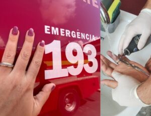 "Anel entalado": Em Manaus, a cada ano, mais de 400 pessoas são socorridas com anéis presos nos dedos