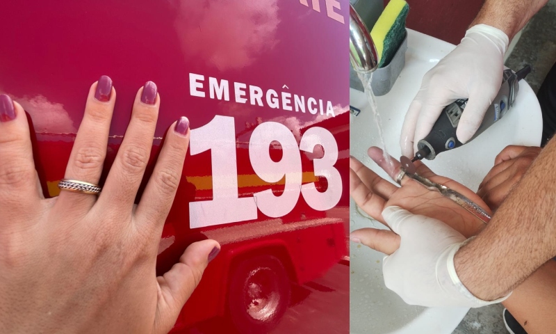 "Anel entalado": Em Manaus, a cada ano, mais de 400 pessoas são socorridas com anéis presos nos dedos